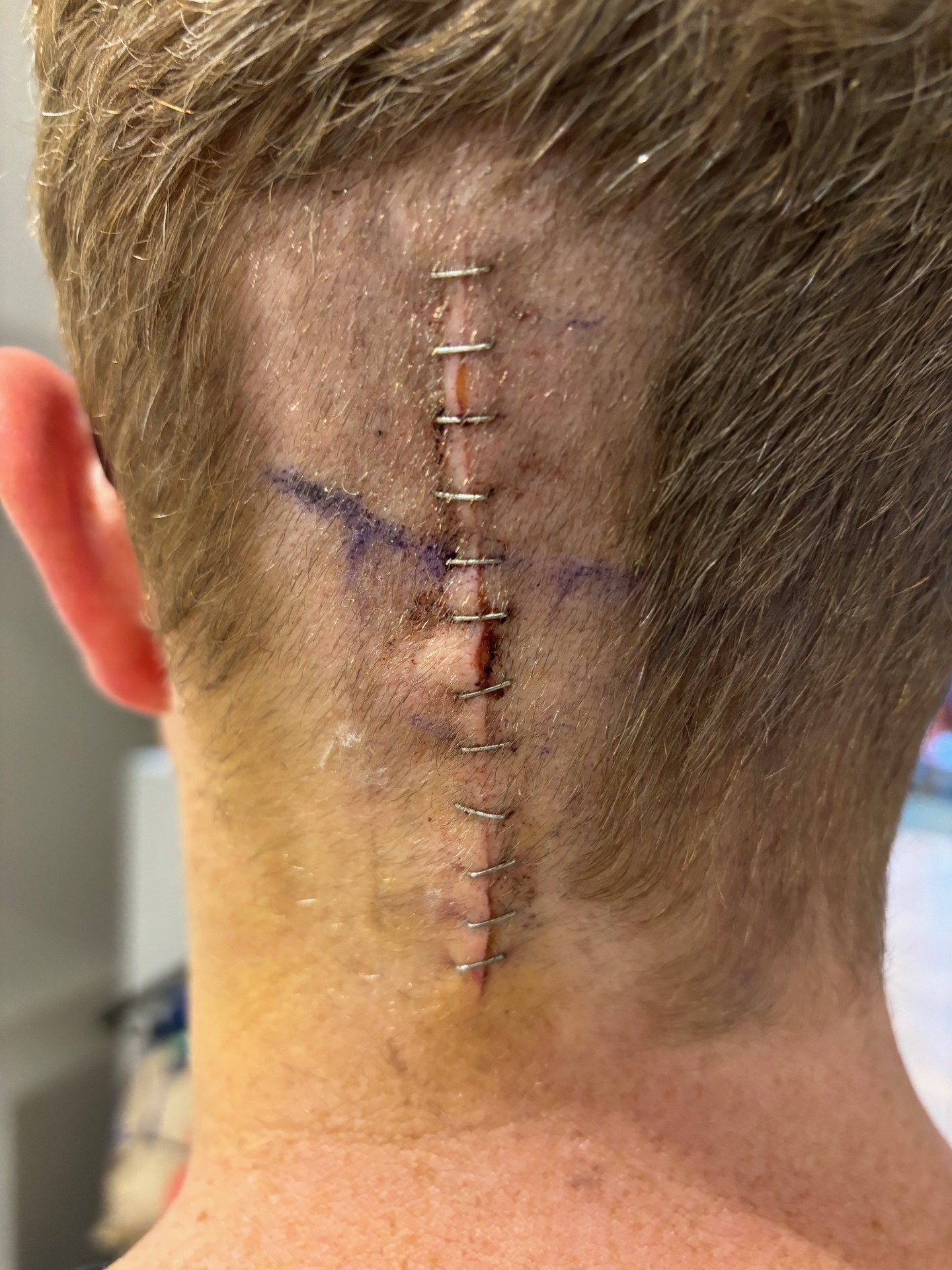 Post brain surgery wound